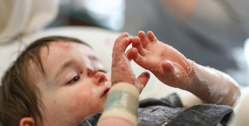 A child suffering from a genetic disease.